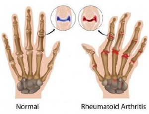 _wsb_354x273_11578737-la-artritis-reumatoide-de-articulaciones-de-los-dedos-de-la-mano